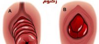 همه چیز درباره افتادگی روده و درمان آن