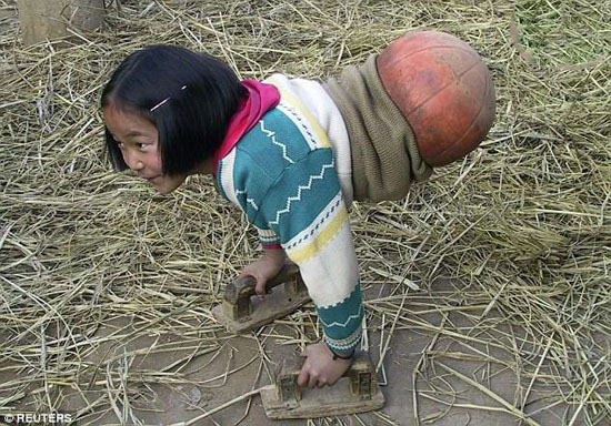 دختری که پاهایش یک توپ بسکتبال است + عکس