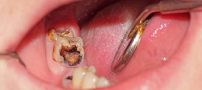 لثه این دختر مکان زندگی 15 کرم زنده است + عکس