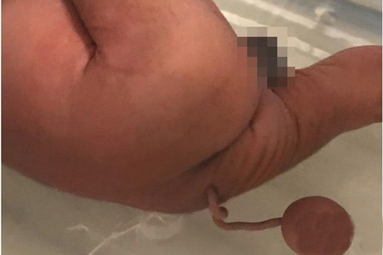 تولد نوزادی عجیب الخلقه با دم دراز و عجیب + عکس 18+ تولد نوزادی عجیب الخلقه با دم دراز و عجیب + عکس 18+