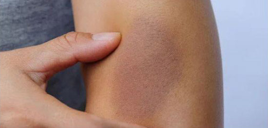 مهمترین نشانه های کمبود ویتامین C در بدن