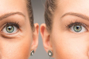 تکنیک ژاپنی ها برای از بین بردن چروک اطراف چشم