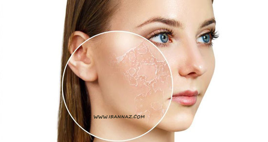 خشکی پوست ، نشانه های پیری زودرس