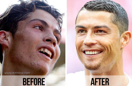 کریستیانو رونالدو - Cristiano Ronaldo ، Dental implant ، ایمپلنت دندان ، ونیر دندان