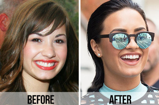 دمی لواتو - Demi Lovato ، Dental implant ، ایمپلنت دندان ، ونیر دندان