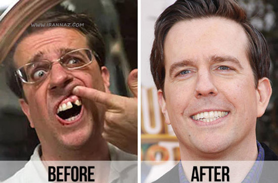 ایمپلنت دندان اد هلمز - Ed Helms ، Dental implant ، ایمپلنت دندان ، ونیر دندان