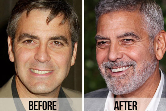 جورج کلونی - George Clooney ، Dental implant ، ایمپلنت دندان ، ونیر دندان