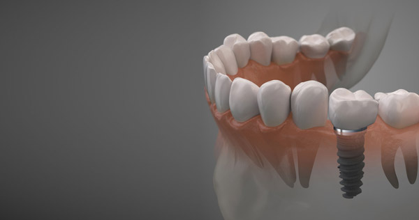از کاشت ایمپلنت پیش از ارتودنسی چه می دانید؟
