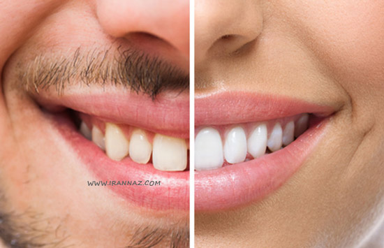 مردان نسبت به زنان دندانهای بزرگتری دارند ، تفاوت های مردان و زنان