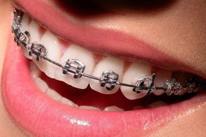 اگر ارتودنسی کرده اید این خوراکی ها را نخورید
