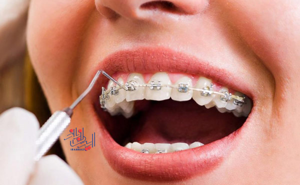 اگر ارتودنسی کرده اید این خوراکی ها را نخورید