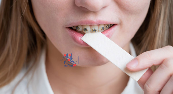 خوراکی های چسبنده مثل آدامس و تافی ، اگر ارتودنسی کرده اید این خوراکی ها را نخورید