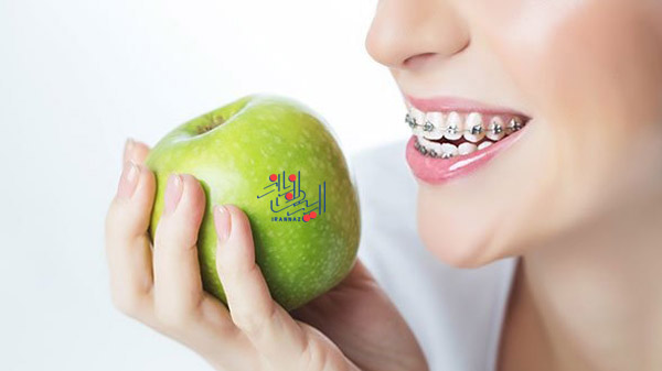 خوراکی هایی که باید گاز بزنید مثل سیب و هویج ، اگر ارتودنسی کرده اید این خوراکی ها را نخورید