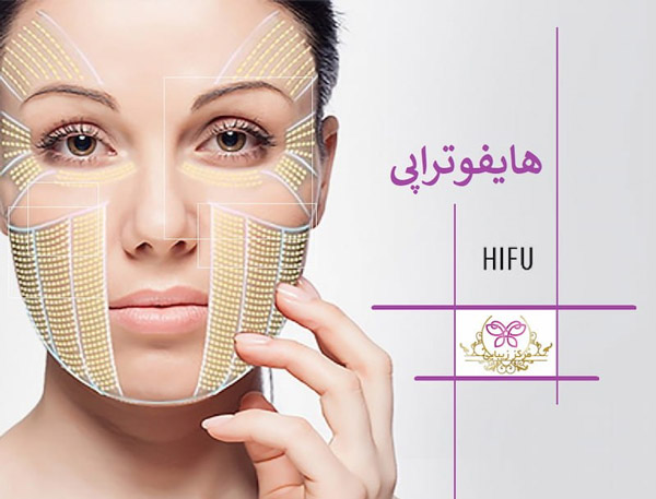 hifu هایفوتراپی در تهران برای لیفت صورت