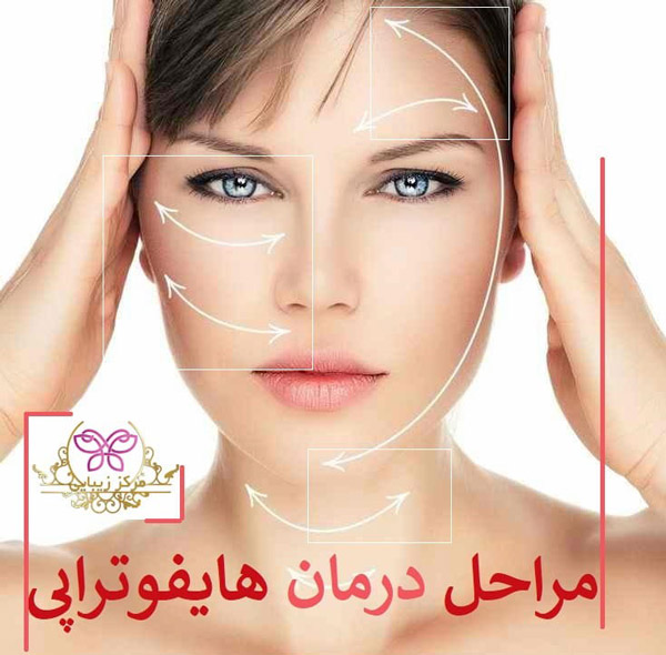 hifu هایفوتراپی در تهران برای لیفت صورت
