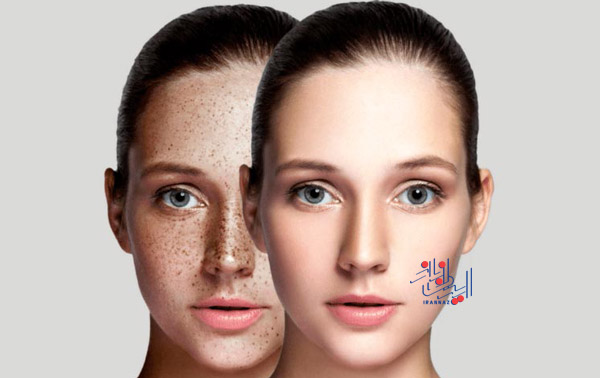 برای از بین بردن لکه ها و رنگدانه ها ، فواید باورنکردنی آب پیاز برای پوست صورت