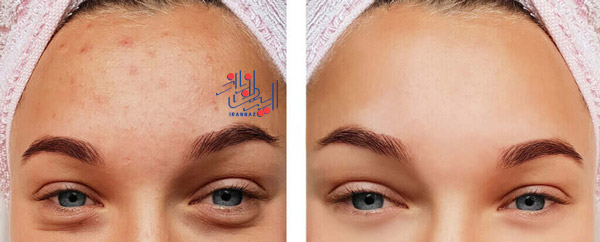 برای درمان آکنه و جوش ، فواید باورنکردنی آب پیاز برای پوست صورت