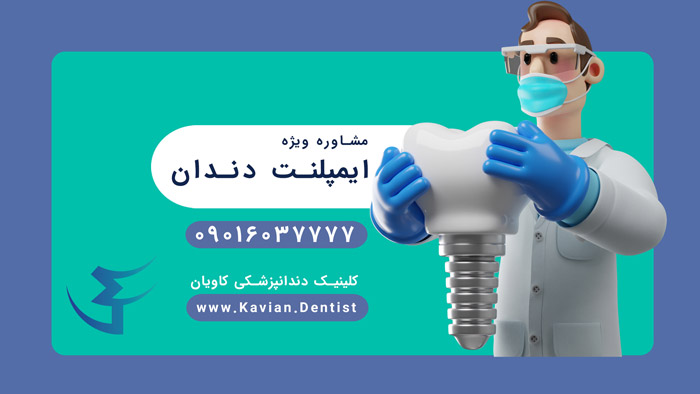ایمپلنت دندان با دکتر مسیح کاویان