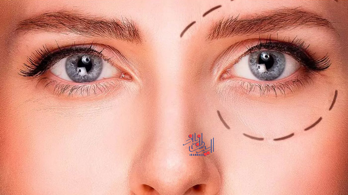 رفع افتادگی پلک با این روش های موثر و خانگی ، Fix drooping eyelids with these effective and home methods