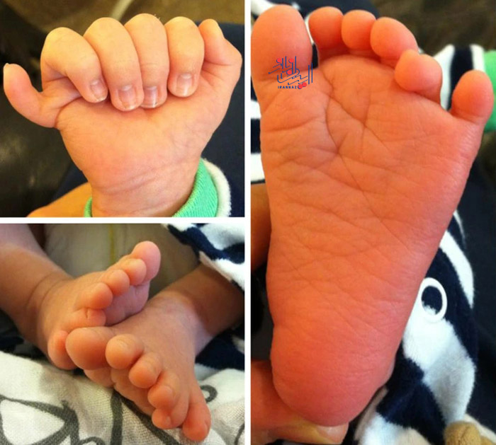 دستها و پاهای این نوزاد 12 انگشت دارد