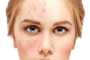 از بین بردن جای زخم، آکنه و جوش با این لبنیات