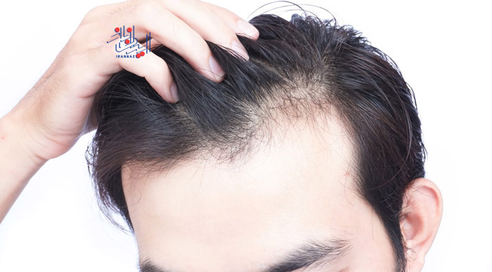 ریزش مو ، عوارض خطرناک استفاده از ژل حالت دهنده مو