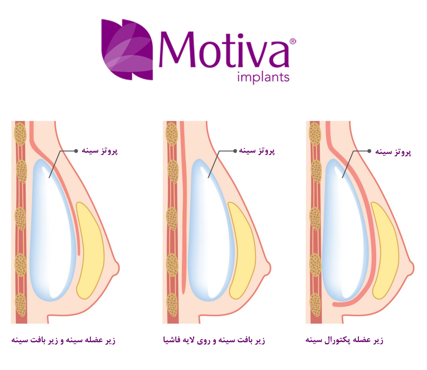 هر آنچه باید در مورد پروتز سینه بدانید