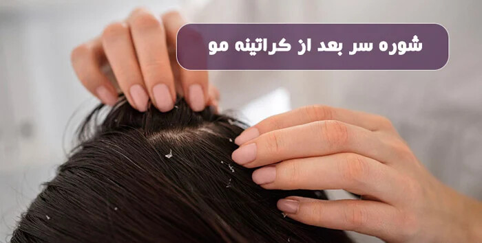 شوره سر بعد از کراتینه مو