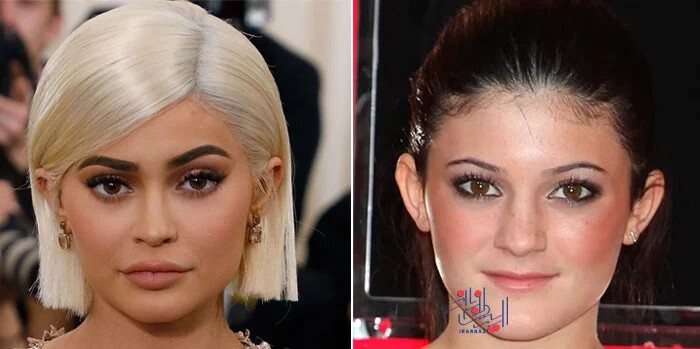کایلی جنر (Kylie Jenner) ، سلبریتی هایی که کارهای زیبایی خود را از بین بردند!!