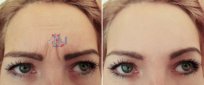 باعث ایجاد چین و چروک می شود ، اخم کردن با چهره و پوست صورت ما چه می کند؟