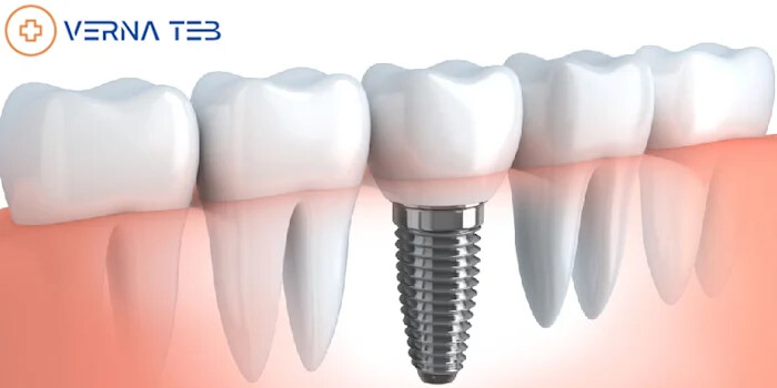 ایمپلنت دندان (Dental Implant)