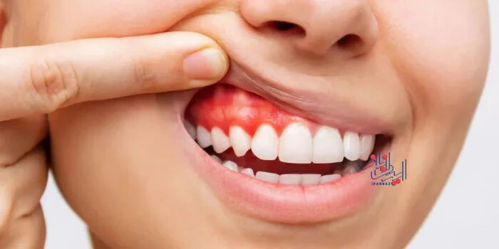 چه چیزی باعث می شود لثه ها بنفش یا قرمز شوند؟