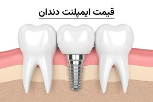 قیمت ایمپلنت دندان