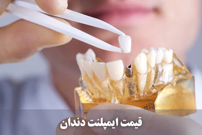 هزینه ایمپلنت دندان