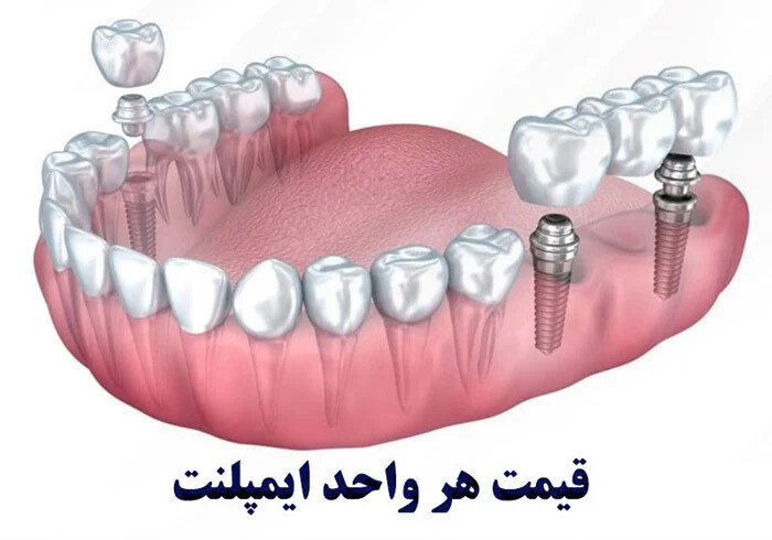 قیمت هر واحد ایمپلنت