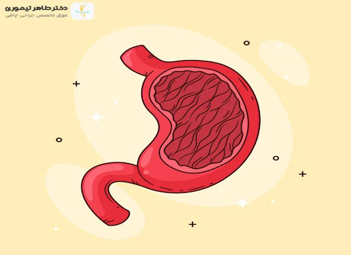 اسلیو معده؛ راه نجات یا یک ریسک بزرگ؟