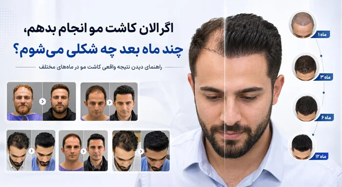 کاشت مو بعد از چند ماه چه تغییری ایجاد میکند