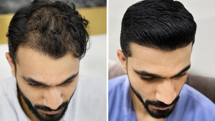 تصویر قبل و بعد کاشت مو برای افزایش تراکم در نواحی کم پشت و طبیعیتر شدن ظاهر کلی موها.