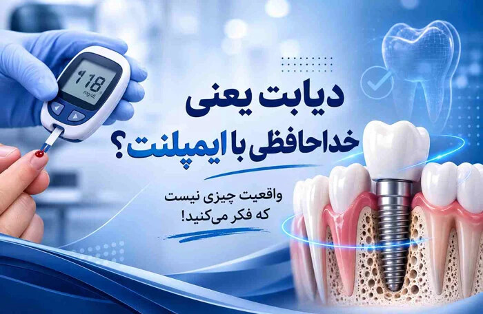 آیا کاشت ایمپلنت برای دیابتی ها امکان پذیر است؟