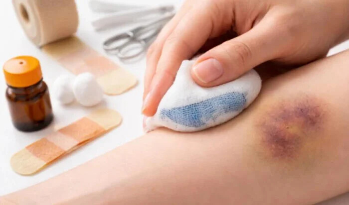 برای کبودی پوست چه کار کنیم؟