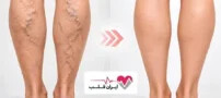 درمان قطعی واریس (بدون جراحی) با بهترین متخصص واریس