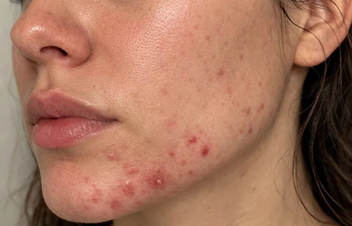 تغییرات هورمونی ، عوامل پیدایش جوش صورت و روش های موثر برای درمان آکنه