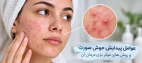 عوامل پیدایش جوش صورت و روش های موثر برای درمان آکنه