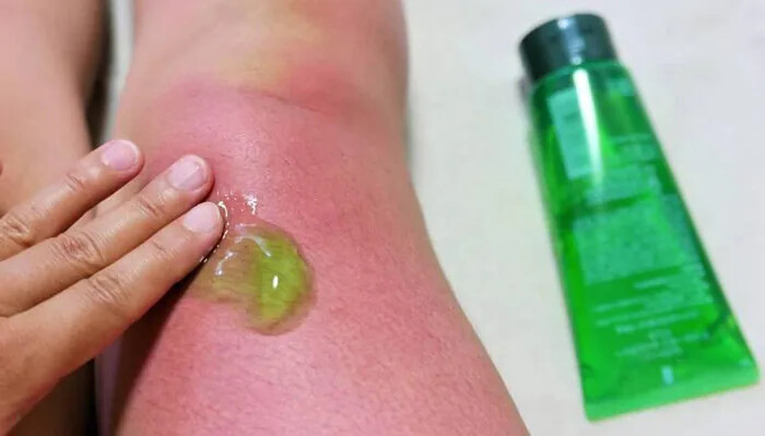 اگر دچار آفتاب سوختگی شدیم چه کنیم؟