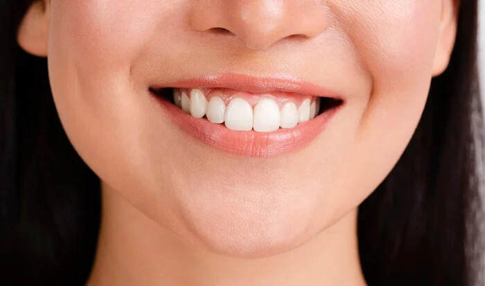 برای سفیدتر شدن دندان ها عجله نکنید