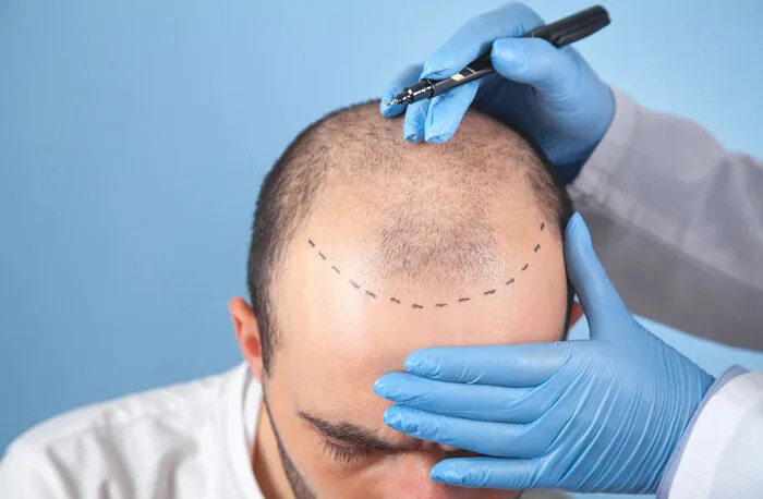 کاشت مو؛ روشی برای بازگرداندن مو به نواحی کم پشت