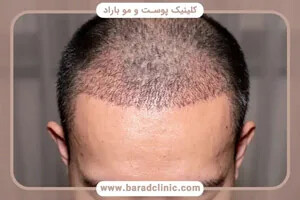 بهترین روش کاشت مو کدام است؟ مقایسه روشها، هزینه و انتخاب کلینیک