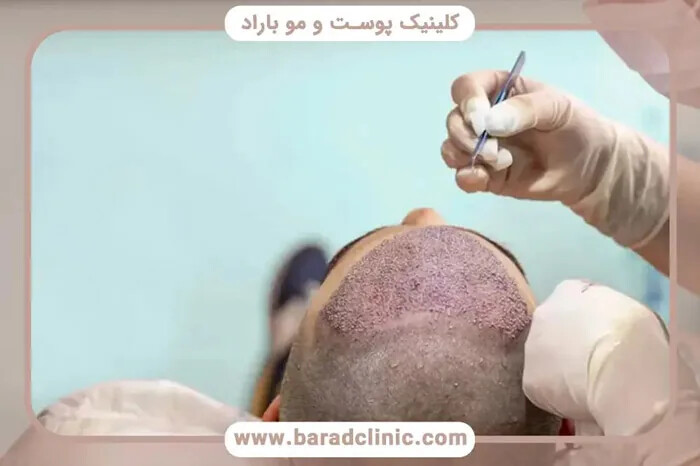 جراحی کاشت مو چیست و چگونه انجام میشود