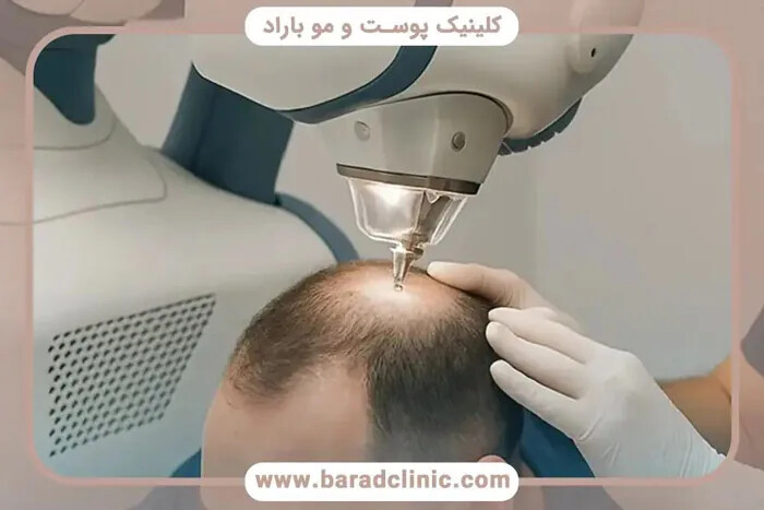 کاشت مو با تراکم بالا در کلینیک باراد