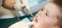 زمان افتادن دندان شیری و رویش دندان دائمی